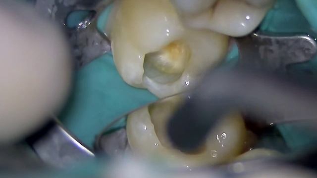 Лечение зубов под микроскопом в стоматологическом клинике "ОМЕГА" смотреть онлайн