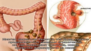 Какая диета показана при дивертикулезе кишечника?