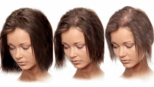 В каких случаях женщины делают пересадку волос?