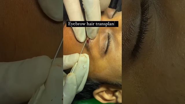 Eyebrow hair transplant/eyebrow/hair transplant/scar hair transplant/fue/dermatologist Surat