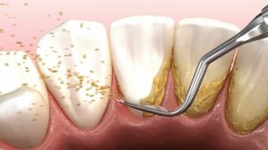 Гигиена полости рта ультразвуковая машина для чистки зубов, удаляющая зубной камень и зубной налет