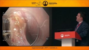Эндоскопическое лечение дивертикула Ценкера. Что может быть нового?