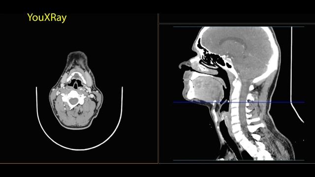 Базовая КТ анатомия шеи смотреть онлайн