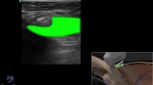 3D-пособие: ультразвуковое исследование кисты Бейкера — SonoSite