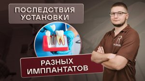 ПОСЛЕДСТВИЯ УСТАНОВКИ РАЗНЫХ ИМПЛАНТАТОВ. Чем чревата установка разных ДЕНТАЛЬНЫХ ИМПЛАНТАТОВ ?