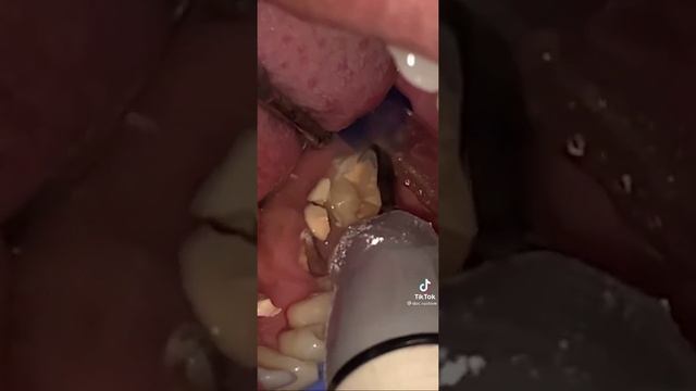 Зубной камень #зубнойкамень #teeth #шок