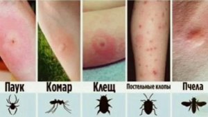 Як виглядає укус Павука, Комара, Клеща, Постельного клопа и Пчели!