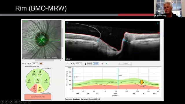 Toshbro Webinar on "Advanced Imaging for Glaucoma Evaluation" смотреть онлайн