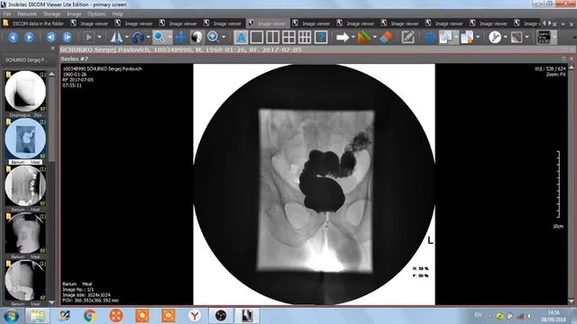 ИРРИГОСКОПИЯ ИРРИГОГРАФИЯ РЕНТГЕНОГРАФИЯ смотреть онлайн