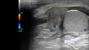 УЗИ мошонки - Травматический эпидидимит