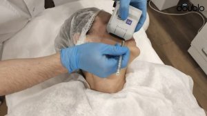 Smas-лифтинг Doublo: подготовка к процедуре (разметка)