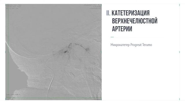 Эмболизация верхнечелюстной артерии