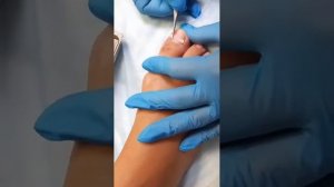 Установка BS пластины (лечение вросшего ногтя) - Эстетико-подологический центр Елены Басковой