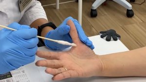 Удаление новообразований жидким азотом