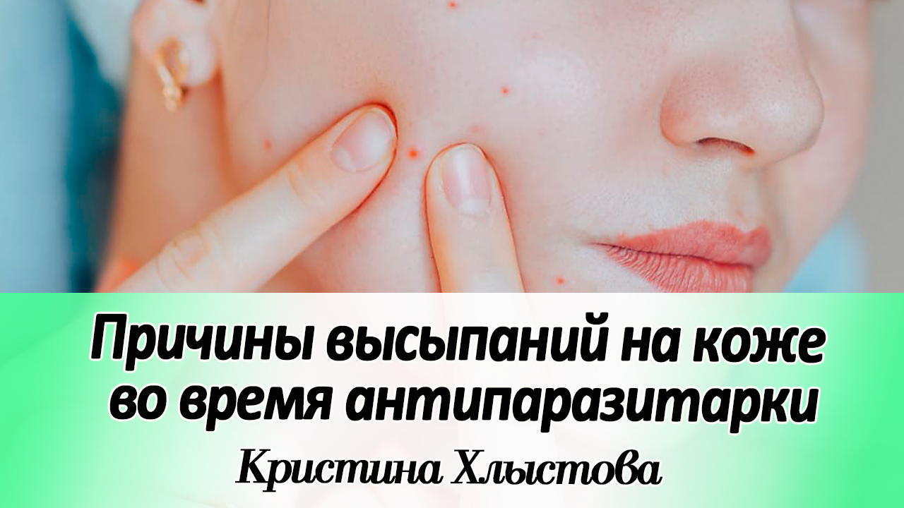 Причины высыпаний на коже во время антипаразитарной и противогрибковой программ | Кристина Хлыстова