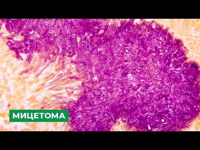 Мицетома. Грибковый гайморит. Симптомы, диагностика и лечение. Советы врача-ЛОР