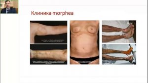 Современный взгляд на классификацию и методы лечения локализованной склеродермии