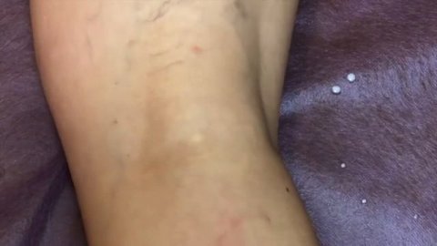 Склеротерапия телеангиоэктазий и ретикулярных вен.