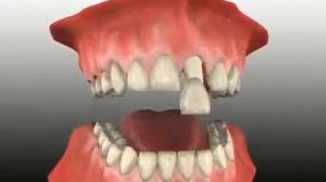 Отличие полностью керамической коронки от металлокерамической