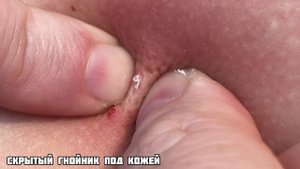Обнаружили под кожей скрытые угри. Давим гнойные прыщи.