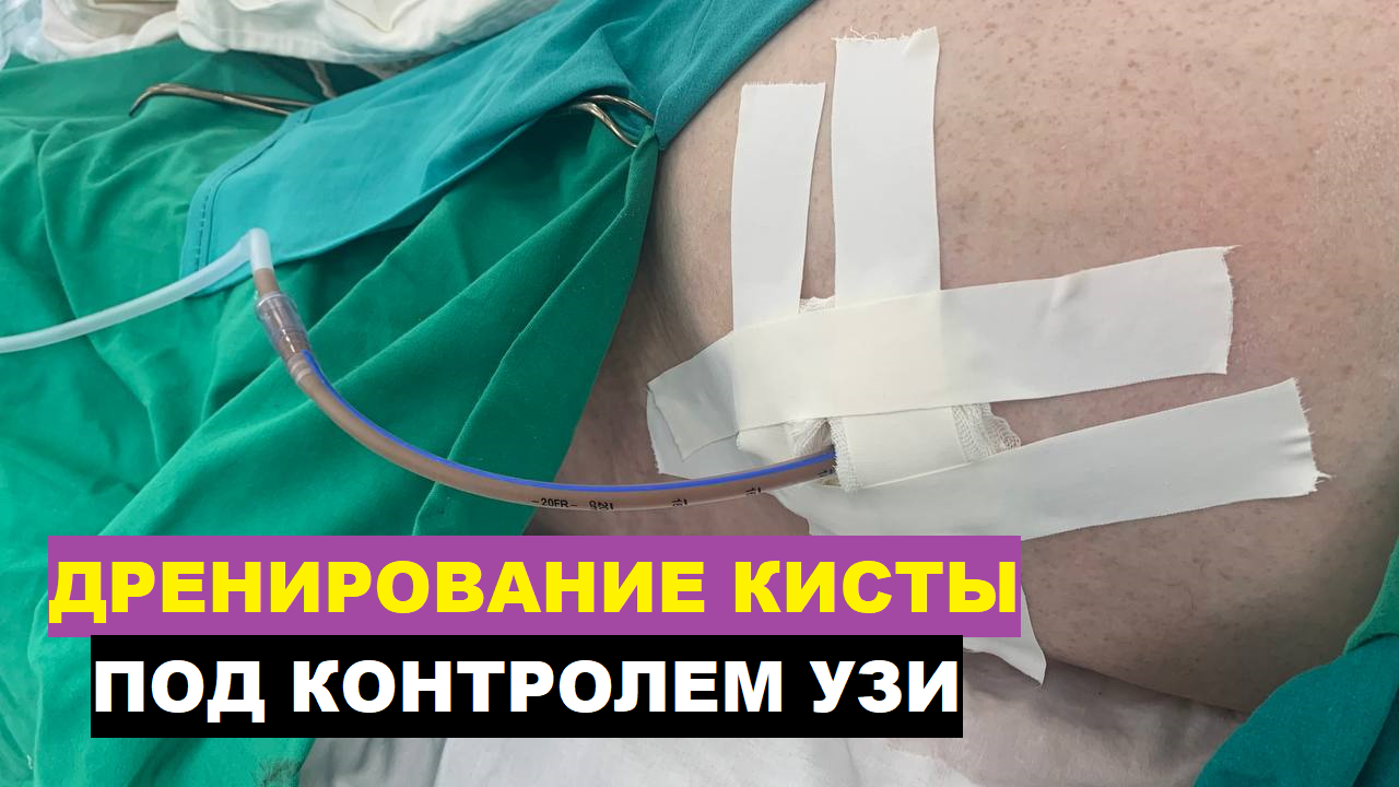Дренирование КИСТЫ брюшной полости под контролем УЗИ