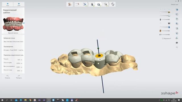 Хирургический Шаблон для установки дентального имплантата Guided Surgury dental implants Stas Belou