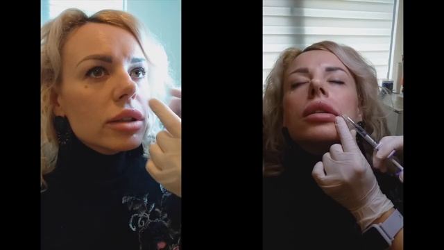УВЕЛИЧЕНИЕ ГУБ В АНТАЛИИ/ЦЕНА/Juvederm/ VLOG#4