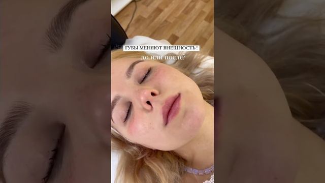 Увеличение губ в авторской технике «Natural lips» и повторная коррекция через 6 мес. LL BEAUTY.