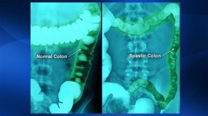 2.23. Массаж при хронических колитах | Медицинский массаж. Цикл 2