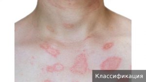 Многоформная эритема  Как лечить многоформную эритему