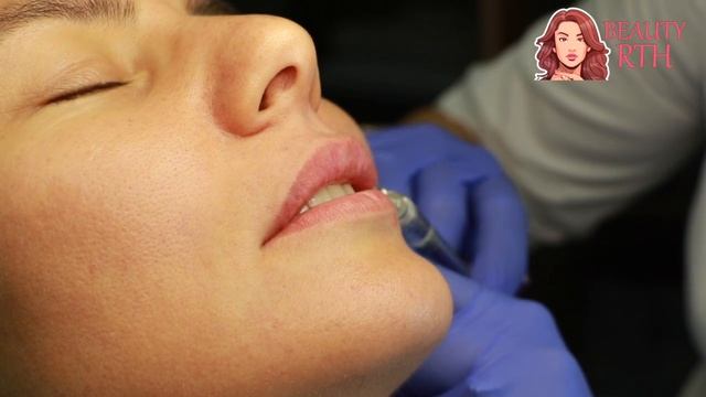 Натуральное увеличение губ филлерами гиалуроновой кислоты смотреть онлайн