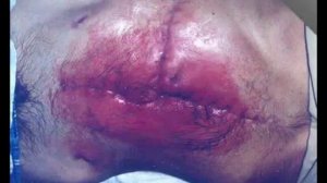 Свищи кишечные. Лечение.