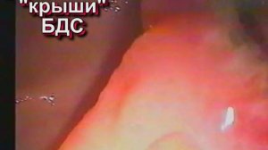 Атипичная эндоскопическая папиллосфинктеротомия.