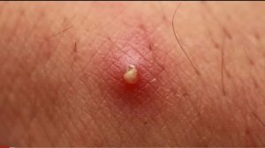 Как Избавиться От Прыщей_Акне -  Доктор Вивек Джоши