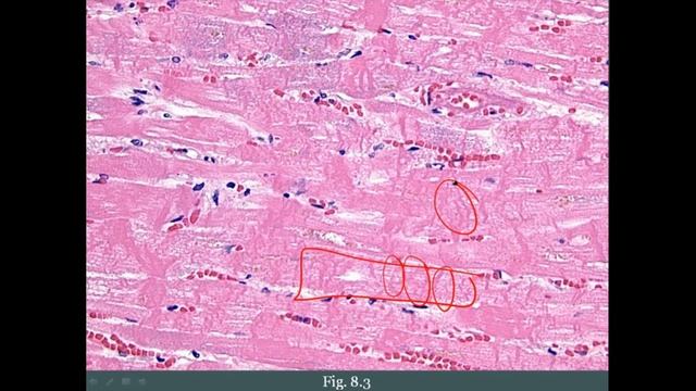 Pathoma USMLE - VIII ГЛАВА - Ишемическая болезнь сердца (ИБС)