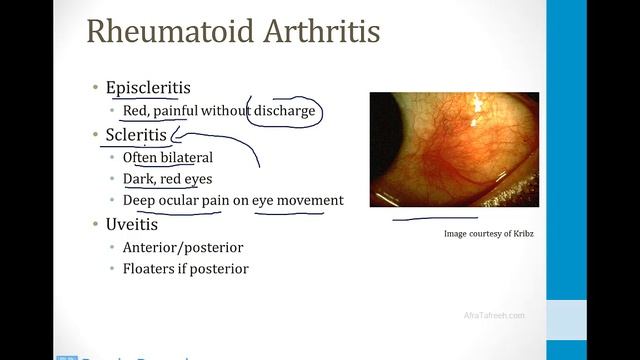 Иммунология USMLE - 4. Аутоиммунные заболевания - 2.Ревматоидный артрит