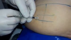 Zoladex implant with anaesthetic