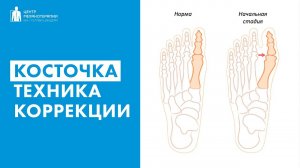 Косточка на стопе (халюс вальгус) | техника для профилактики и коррекции