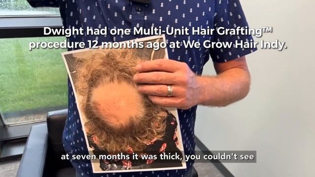VIP Dwight Witten's Multi-Unit Hair Grafting™ Results смотреть онлайн