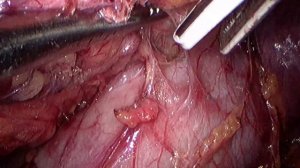 Лапароскопическая радикальная нефрэктомия справа.