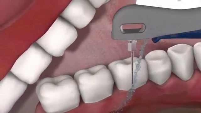 Как работает наконечник Vector Paro, Durr Dental смотреть онлайн