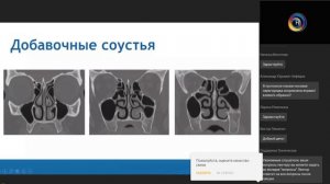 Компьютерная томография придаточных пазух носа перед FESS