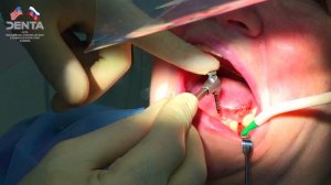 Имплантация зубов. Реальная операция