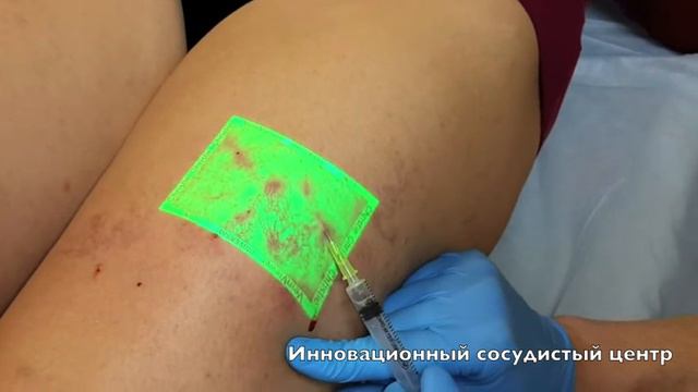 Veinviewer - склеротерапия