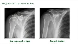 Рентген диагностика заболеваний плечевого сустава | Травматология и ортопедия