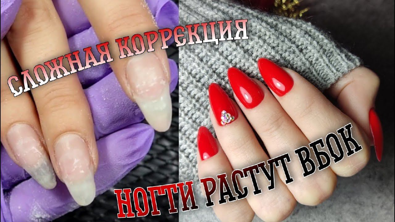 Сложная коррекция ногти растут вбок↩