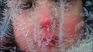 обморожение