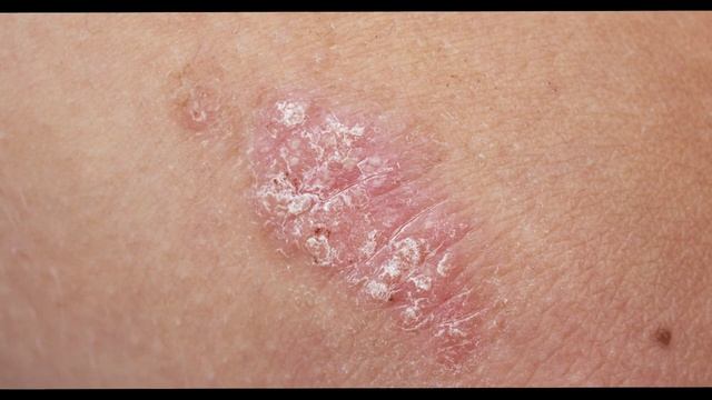 Как лечить потницу у взрослых смотреть онлайн