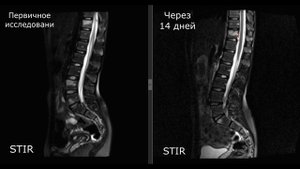 ХРОНИЧЕСКИЙ ОСТЕОМИЕЛИТ / МРТ / НАТАЛЬЯ МЕДВЕДЕВА/ MOSCOW RADIOLOGY TEAM