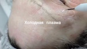 Обработка холодной плазмой.